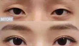 各类网红双眼皮,多样美眸的时尚演变解析